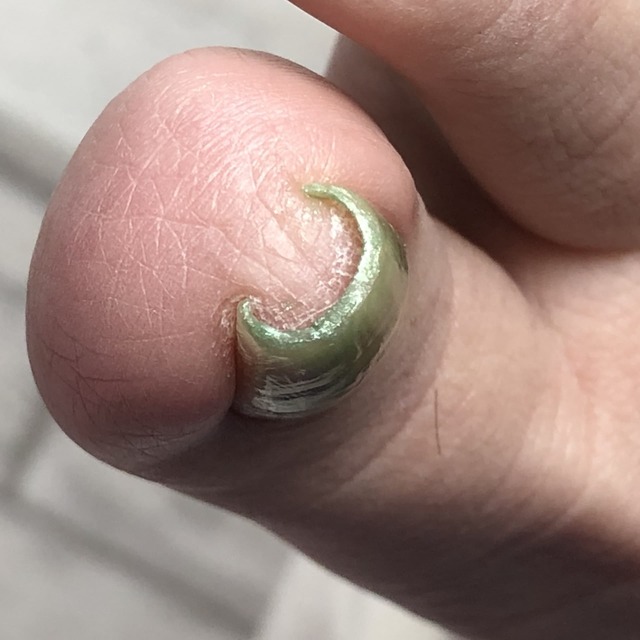 トラブル爪ケア